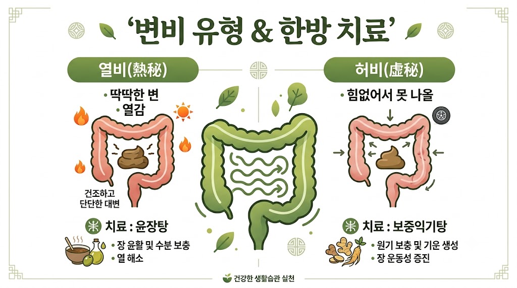 변비 치료 인포그래픽