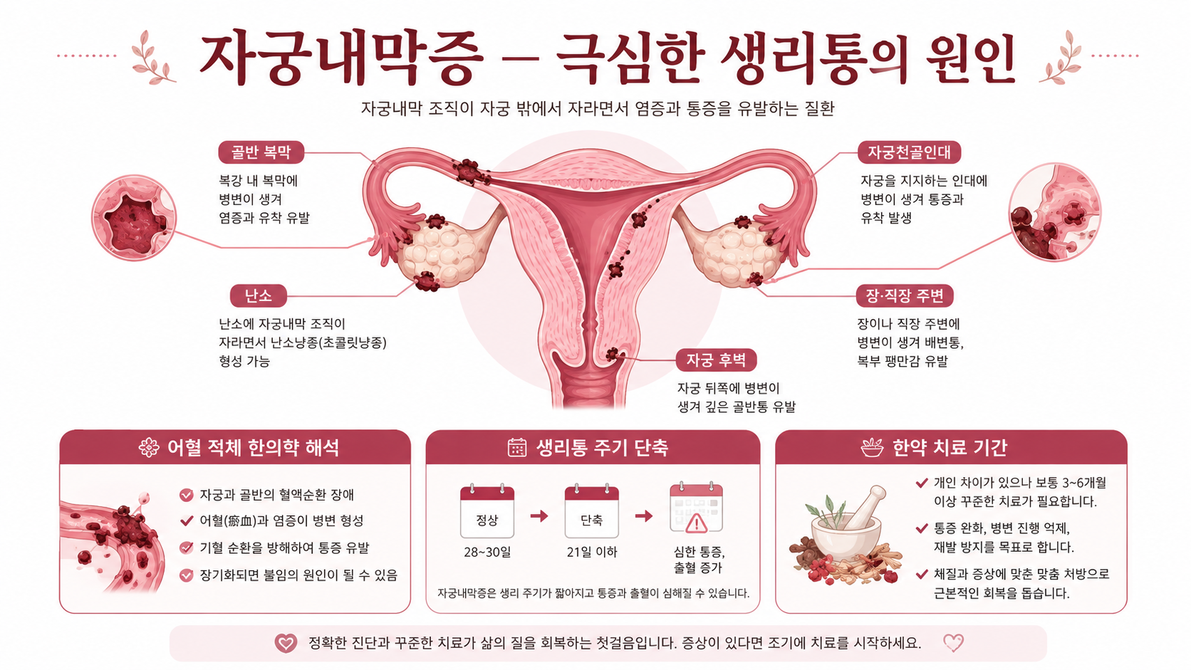 갱년기 우울 감정 인포그래픽