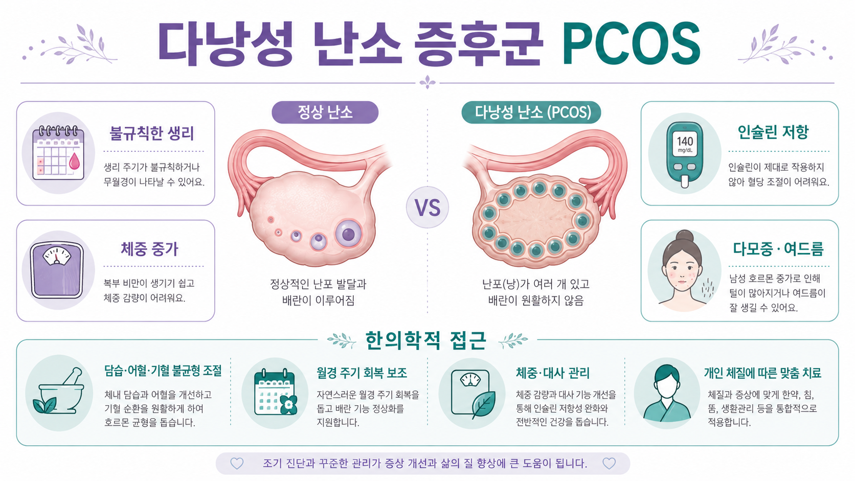 PCOS 다낭성 난소 증후군 인포그래픽