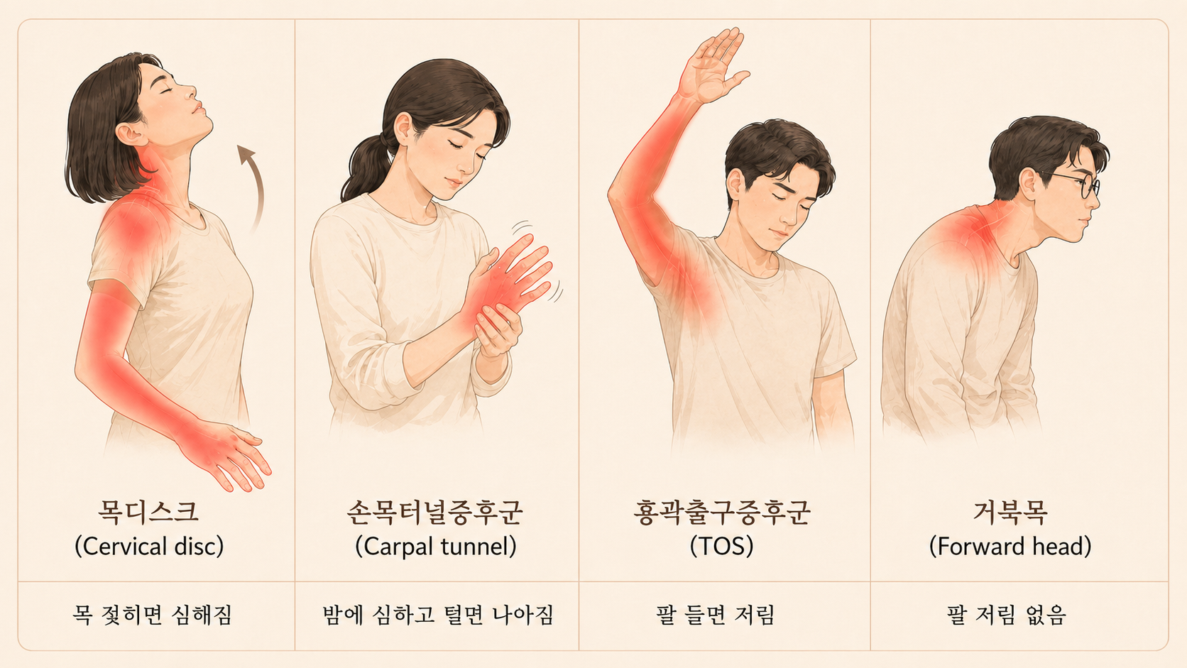 팔 저림 4가지 감별 - 목디스크, 손목터널증후군, 흉곽출구증후군, 거북목