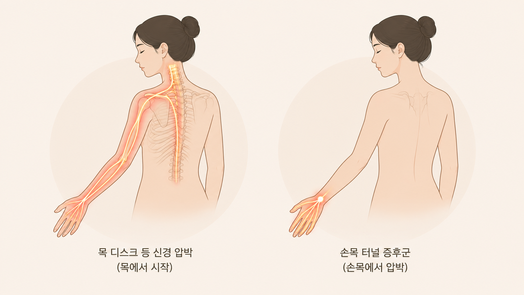 목디스크 vs 손목터널증후군 신경 경로 비교