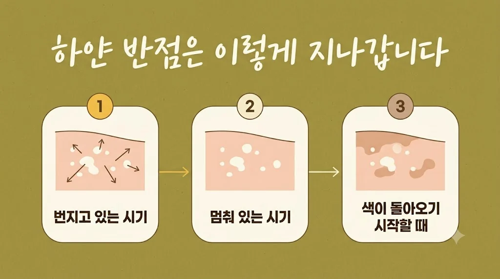 인천 송도 더율한의원 - 백반증 증상